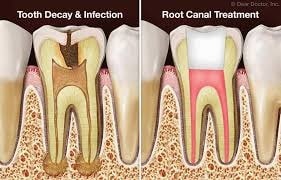 Root Canal Treatment1-min